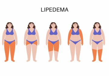 Dolor, hinchazón y dificultad para caminar: así impacta el lipedema en la vida de las mujeres