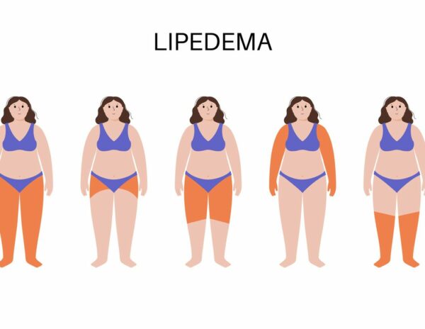Dolor, hinchazón y dificultad para caminar: así impacta el lipedema en la vida de las mujeres