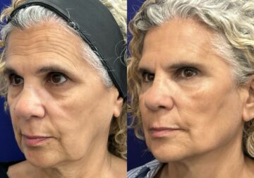 Global Face: nuevo protocolo integral del Dr. Ángel Martín para la recuperación de estructuras faciales, de la firmeza y elasticidad dérmica